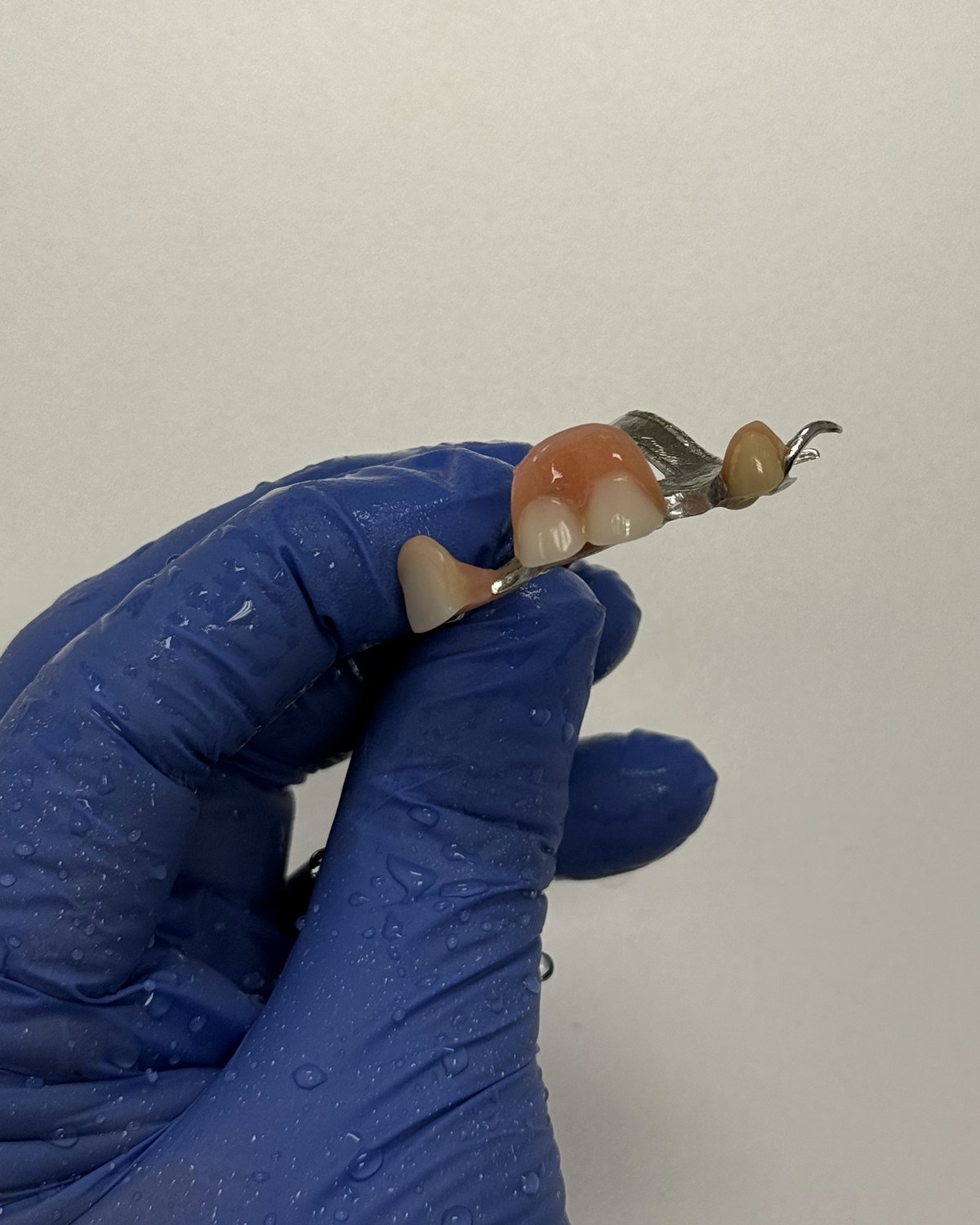 After: repaired metal partial denture