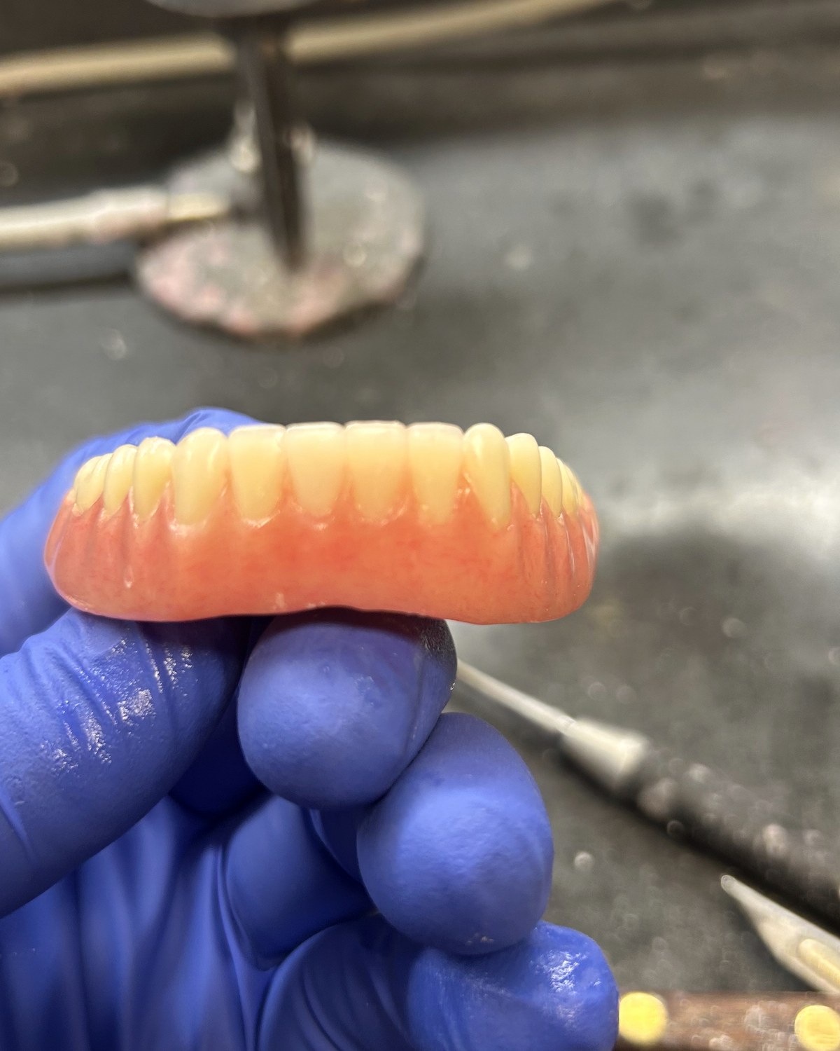 After: two replacement denture teeth installed