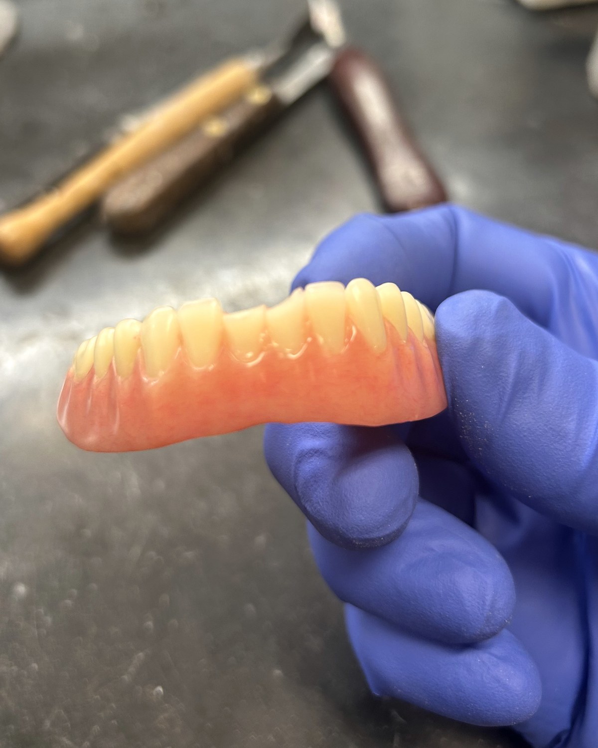 Before: two denture teeth broken